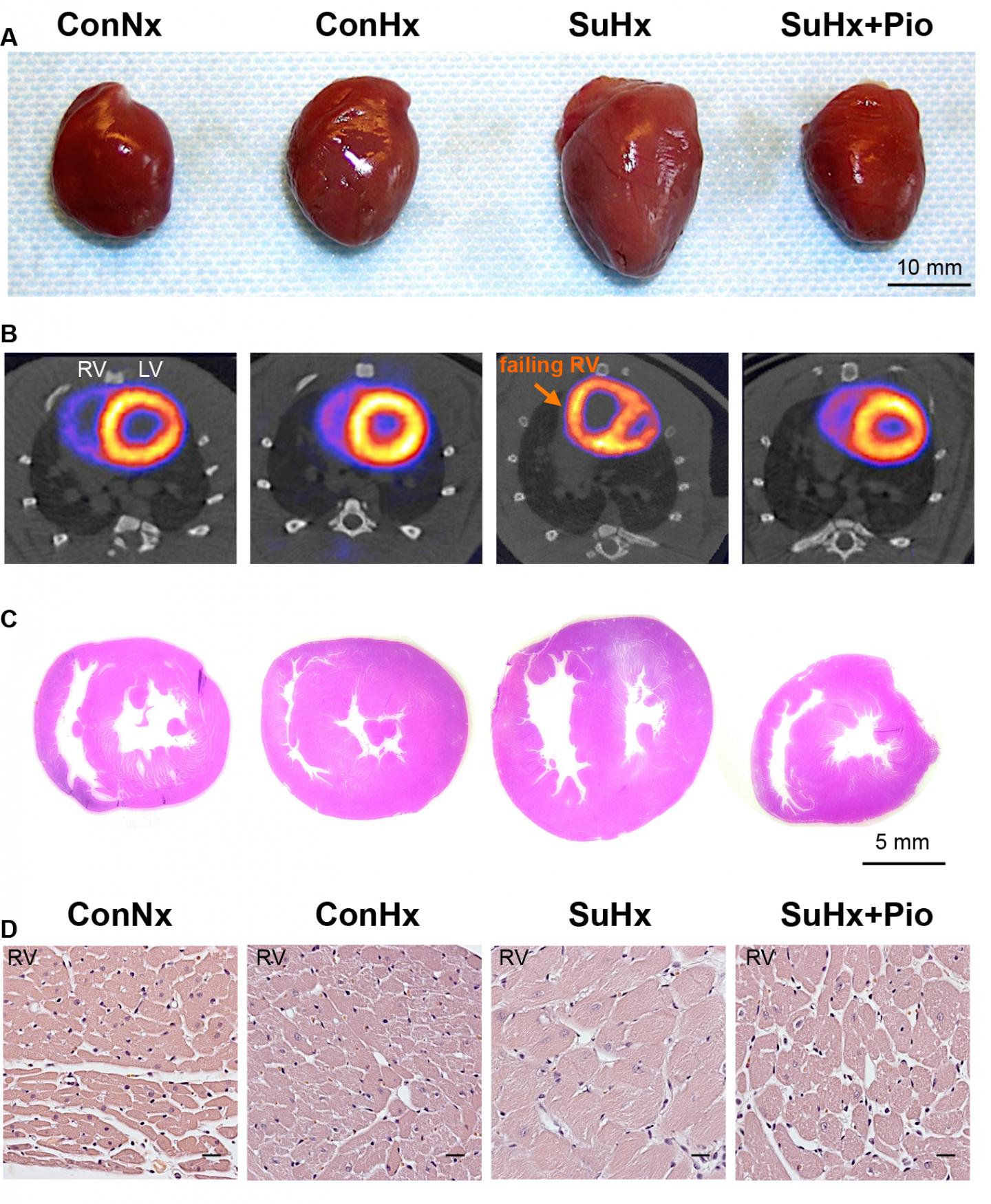 Repurposing A Diabetes Drug For Pulmonary Hyp | EurekAlert!