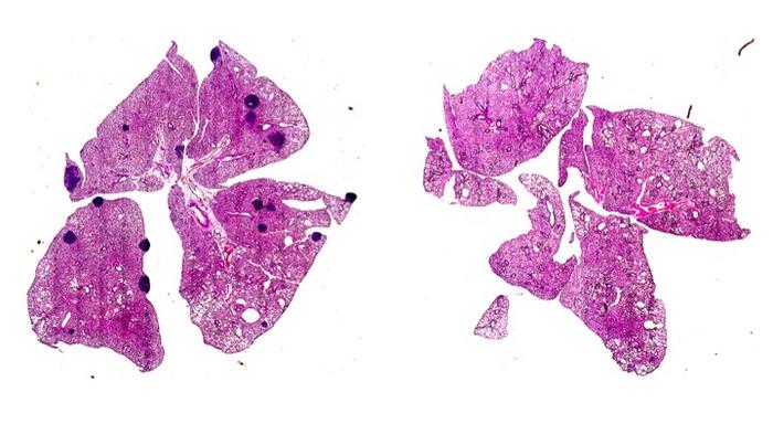 Lung metastases