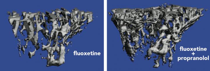 Bone Scans After Treatment with the Antidepressant Fluoxetine