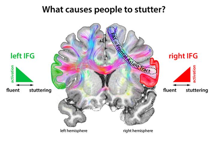 What Causes People to Stutter
