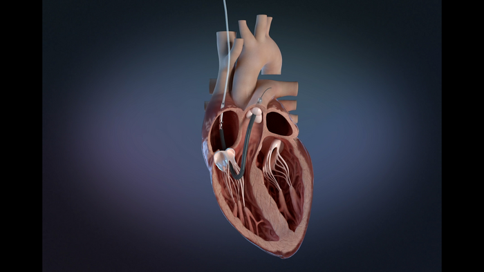 Impella RP Flex with SmartAssist Illustration