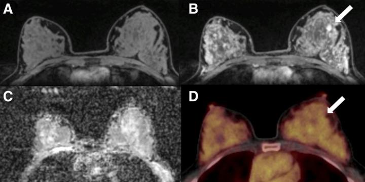 Fifty-Year-Old Postmenopausal Woman with a Fibroadenoma in the Left Breast