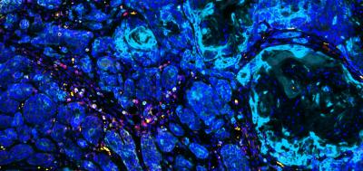 Carcinogen-exposed cells provide clues in fighting treatment-resistant cancers