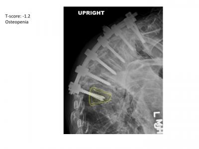 Fracture Following Surgery
