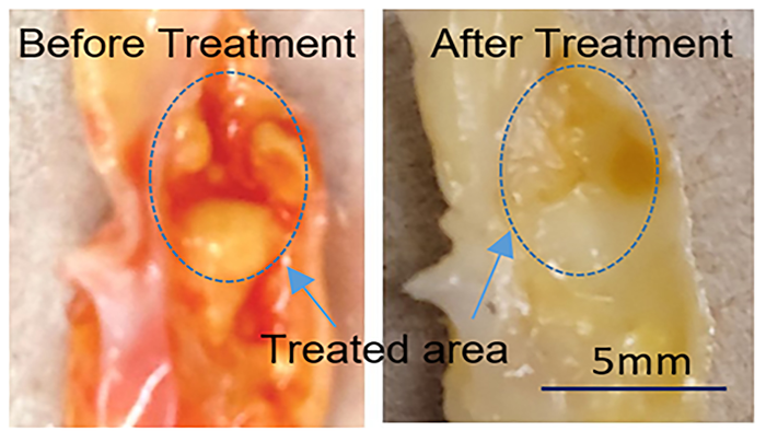 Ultrasound-Assisted Laser Technique Vaporizes Artery Plaque