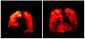 New scan method reveals lung function