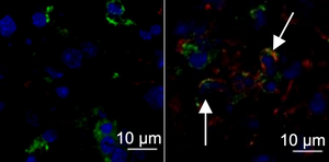 Cancer therapy and Covid-19