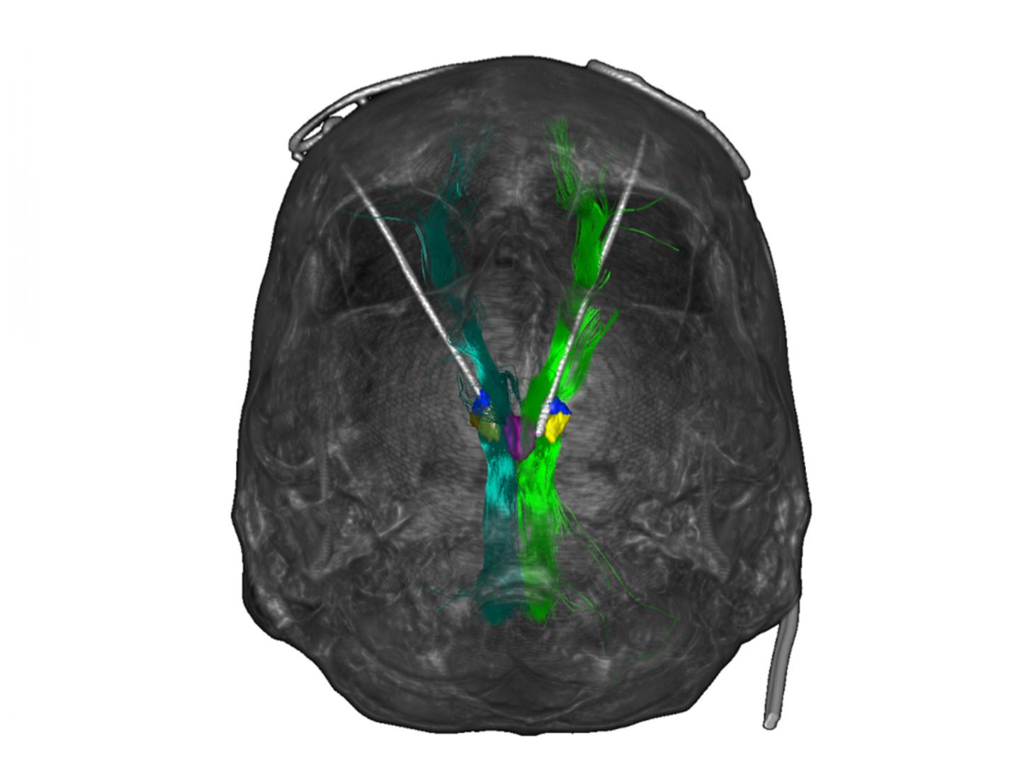 Deep Brain Stimulation