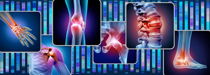 Osteoarthritis: Genetic Underpinnings