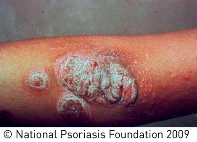 First Gene Linked to Common Form of Psoriasis Identified