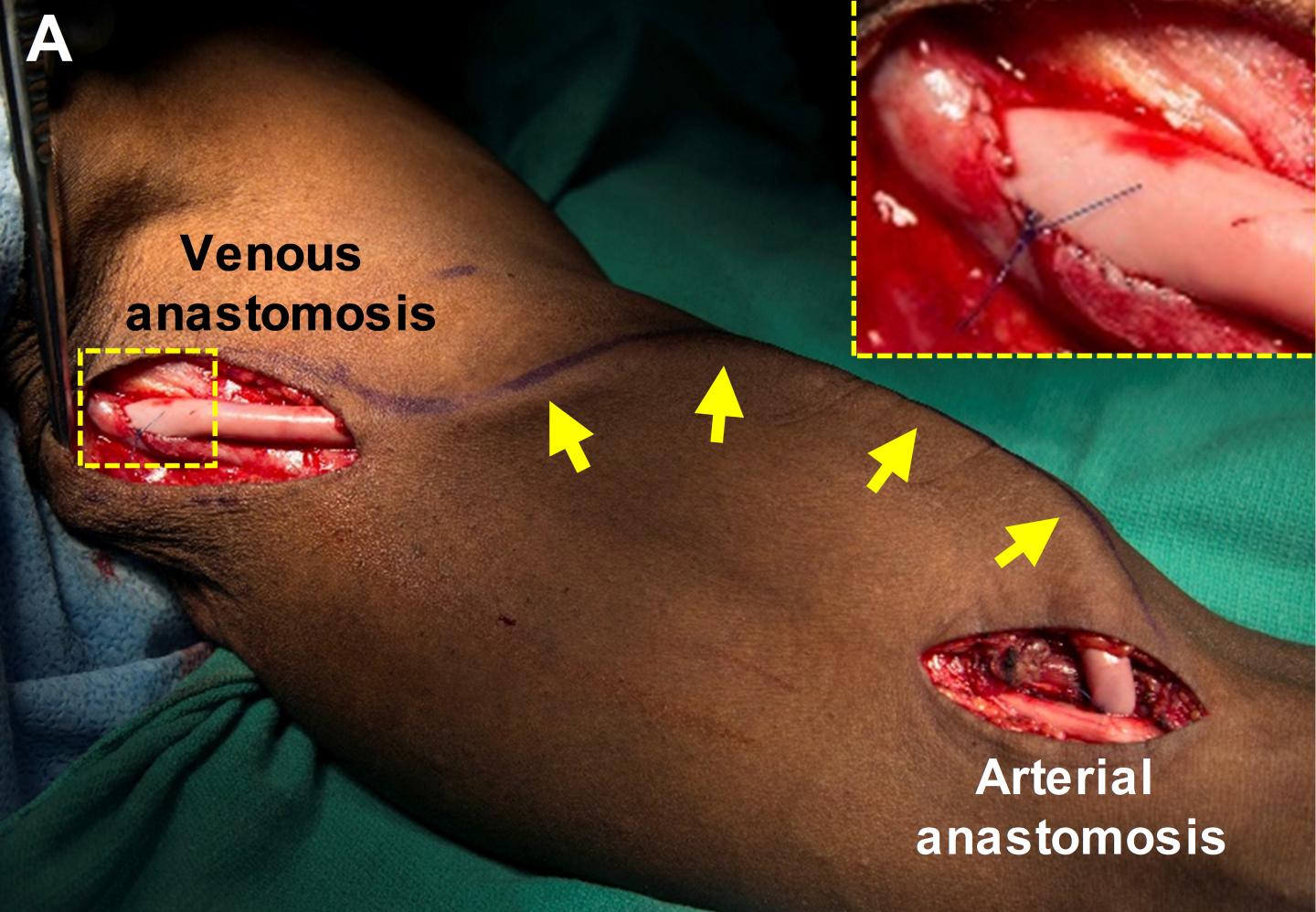 Self-Sustaining, Bioengineered Blood Vessels Could Replace Damaged Vessels in Patients (2 of 2)