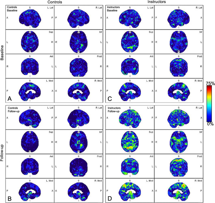 Recurrent Brain Trauma May Increase Alzheimer’s Risk