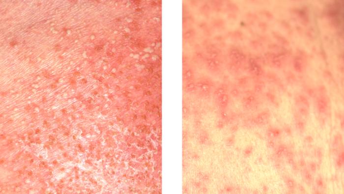 Close-up of skin symptoms