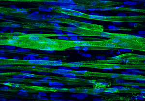 Reconstituted muscle tissue from a donor with Duchenne’s Muscular Dystrophy
