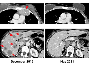 Tumor images, before and after