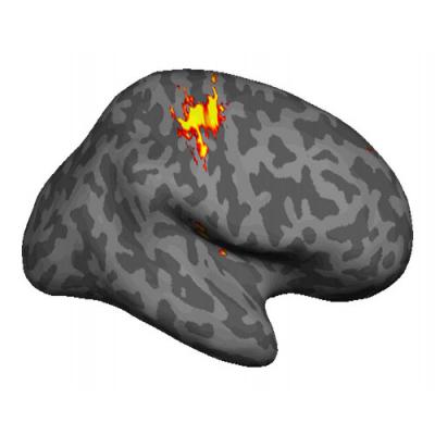 Brain Imaging of Phantom Pain