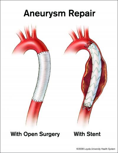 More Aortic Chest Aneurysms Being Treated Wit Eurekalert