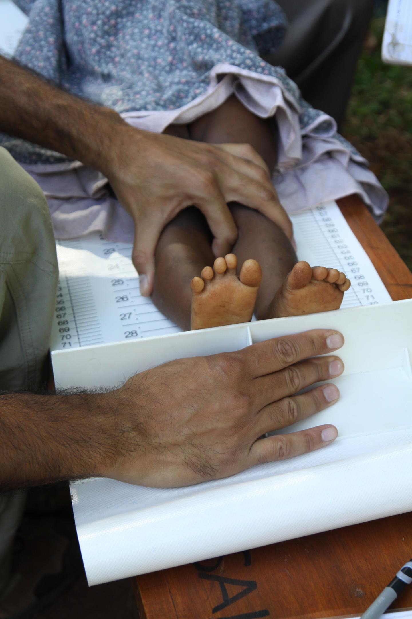 New Approach to Childhood Malnutrition May Reduce Relapses, Deaths