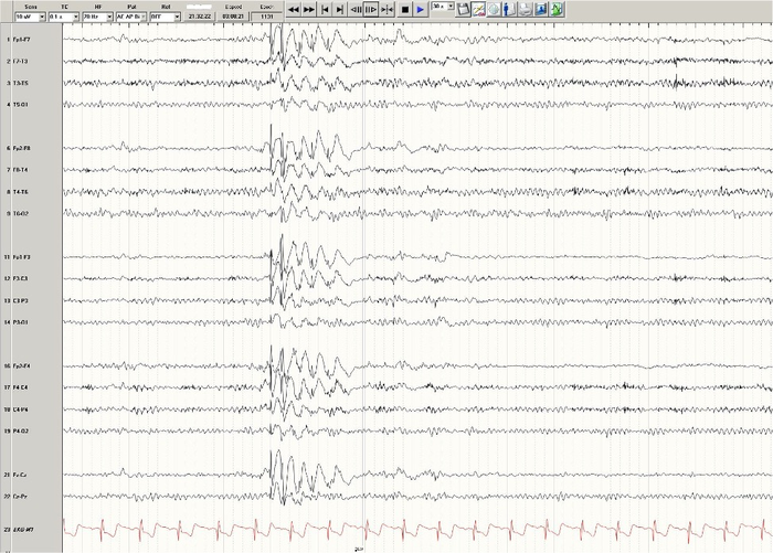 A representative EEG of a patient with generalized Epilepsy.