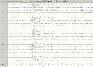 A representative EEG of a patient with generalized Epilepsy.