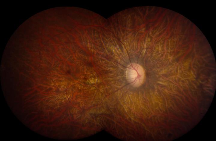 Leber Congenital Amaurosis Retina