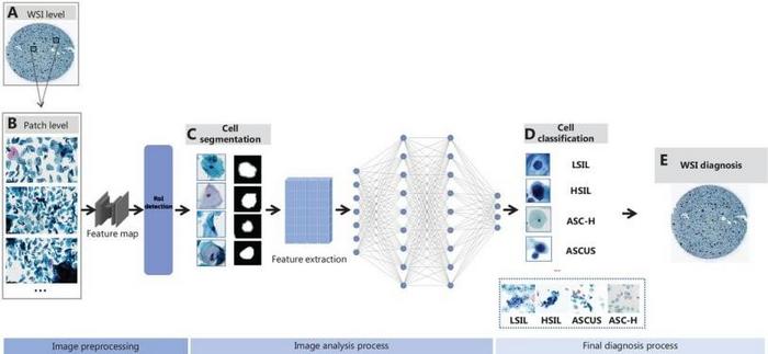 Schematic representation of AI-assisted cervical cytology image analysis.