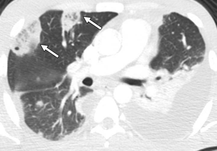 32-Year-Old Man with Septic Pulmonary Embolism Due to Iv Substance Use Disorder.