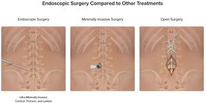 Endoscopic Spine Surgery