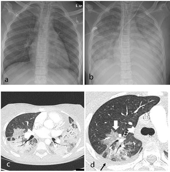 New Study Looks at Post-COVID-19 Emerging Disease in Children