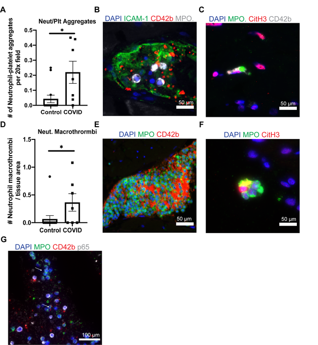 Neutrophils contribute to thrombosis in patients