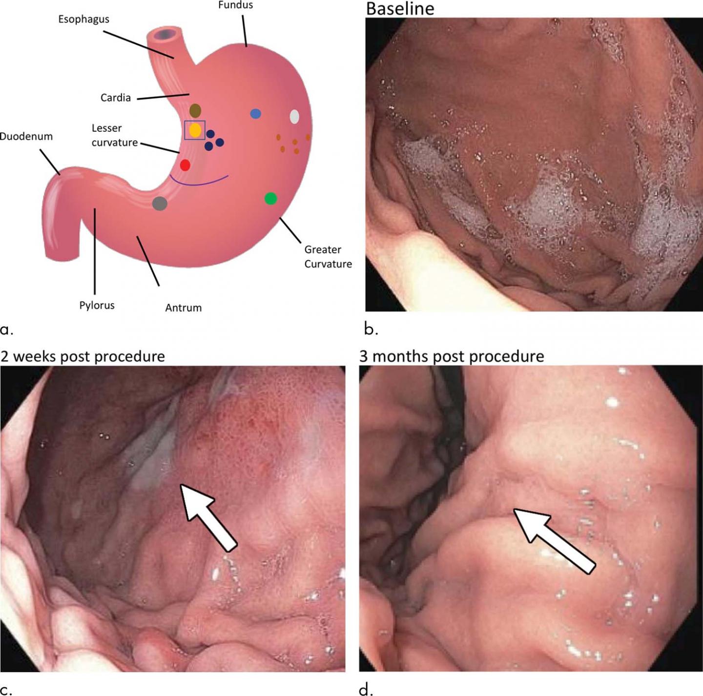 Bariatric Embolization Shows Promise in Treatment of Obesity