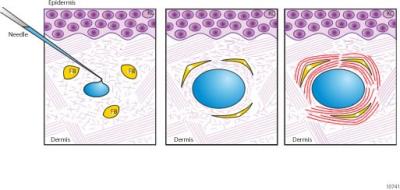Stemming a Tide of Wrinkles