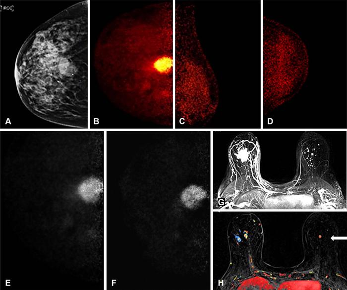 Images obtained in an 85-year-old female patient with a new biopsy-proven malignant lesion in the right breast.