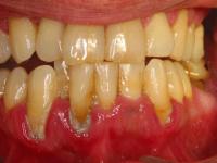 Image of Severe Periodontitis and Plaque