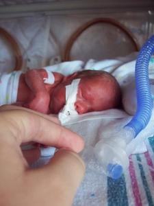 Premature infant with ventilator.