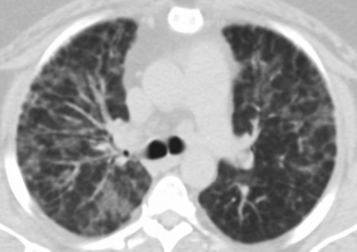 Giant Cell Interstitial Pneumonia Attributed to Vaping in 49 YO Woman