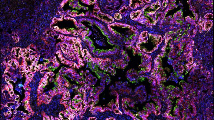 a mouse’s early-stage pancreatic tumor