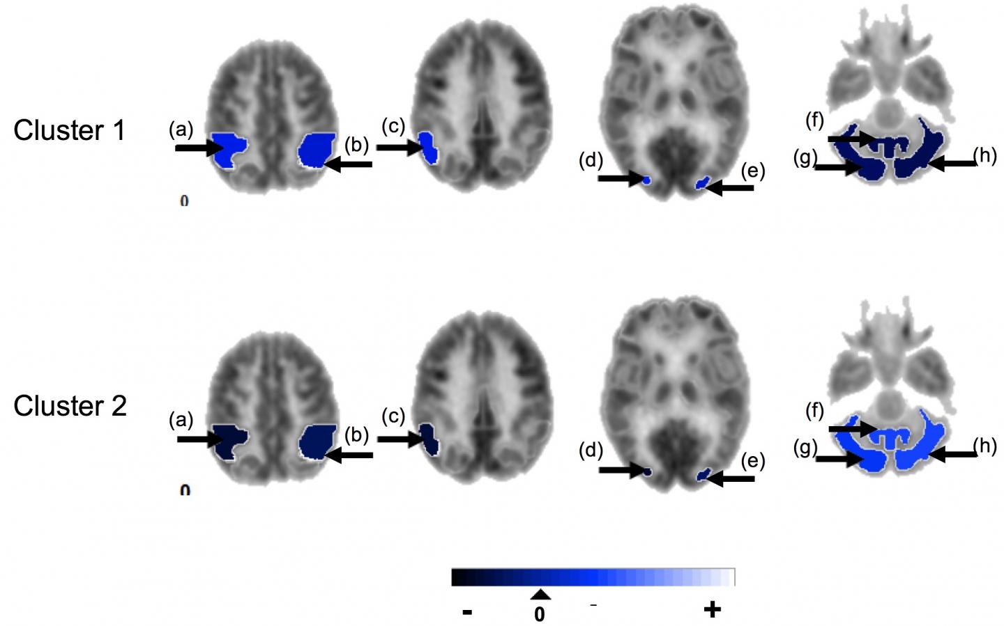 Epilepsy 1 [IMAGE] | EurekAlert! Science News Releases