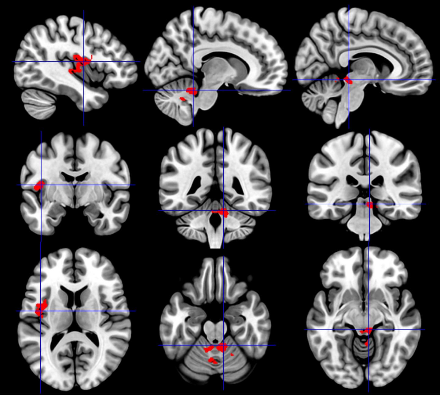 Differentiating CFS from GWI