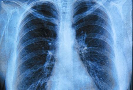Lung Cancer