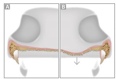 Thematic Diagram Showing Denticulate Plates