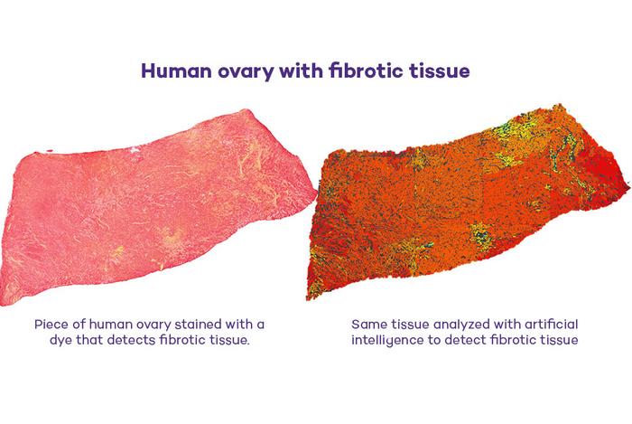 Fibrotic tissue in human ovary