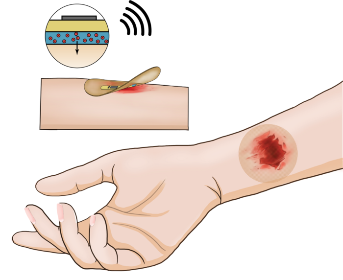 Wireless smart bandage provides new insights on healing chronic wounds