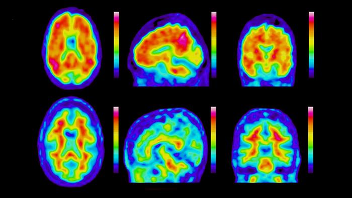 Amyloid protein deposition