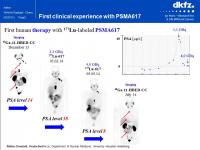 First Human Therapy with Lu-177-labeled PSMA-617