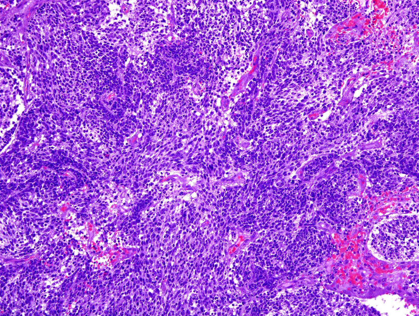 Image of a Glioblastoma, the Most Aggressive Brain Tumor