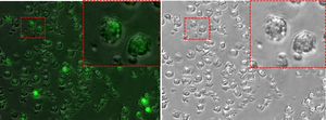 Acute lymphoblastic leukemia cells