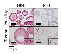 Healthy and Tumor Organoids