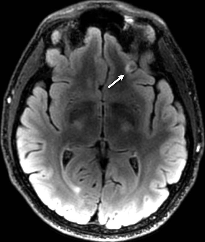 MRI Shows 'Brain Scars' In Mil [IMAGE] EurekAlert! Science News Releases