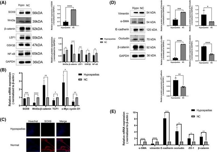 The relative expression of SOX9, Wnt/β-catenin signaling pathway and epithelial-mesenchymal transition markers in hypospadias foreskin tissues.